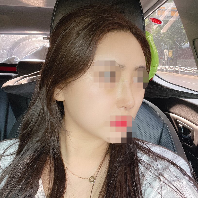 황정일 원장님께 상담을 받아보고 진짜 바로 수술해야겟다고 생각이 바로들더라구요