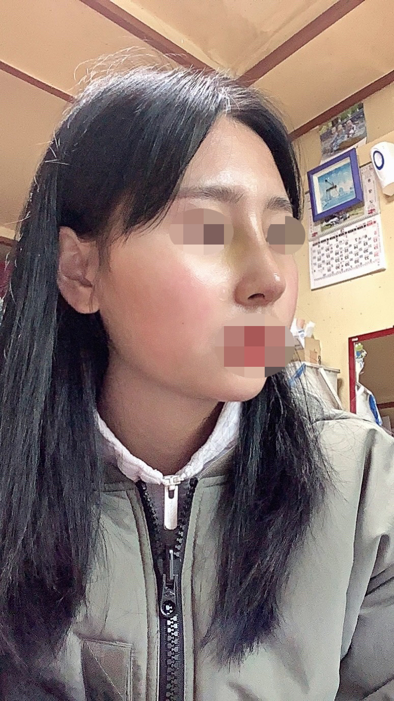 보기싫었던 코모양 코성형 진행
