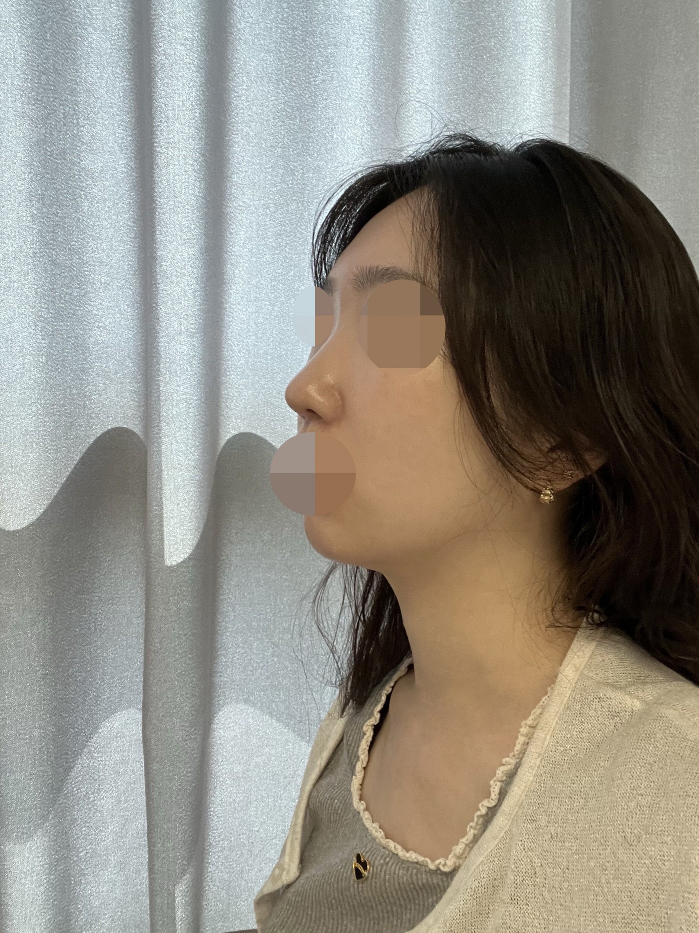 붓기도 적었고 부작용 없이 자연스럽게 돼서 만족해요!