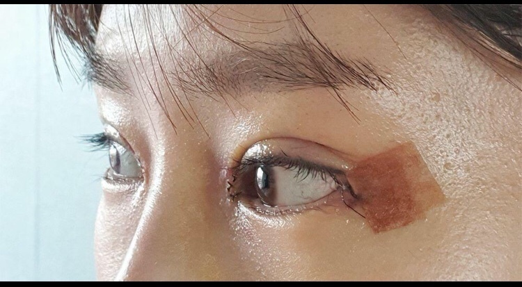 눈 수술 했어요~