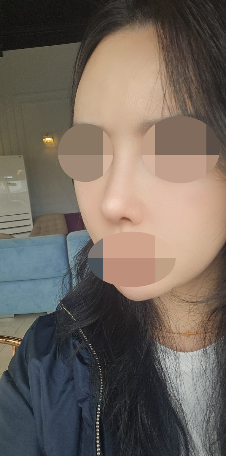 틀창코 휜코 재수술했습니다