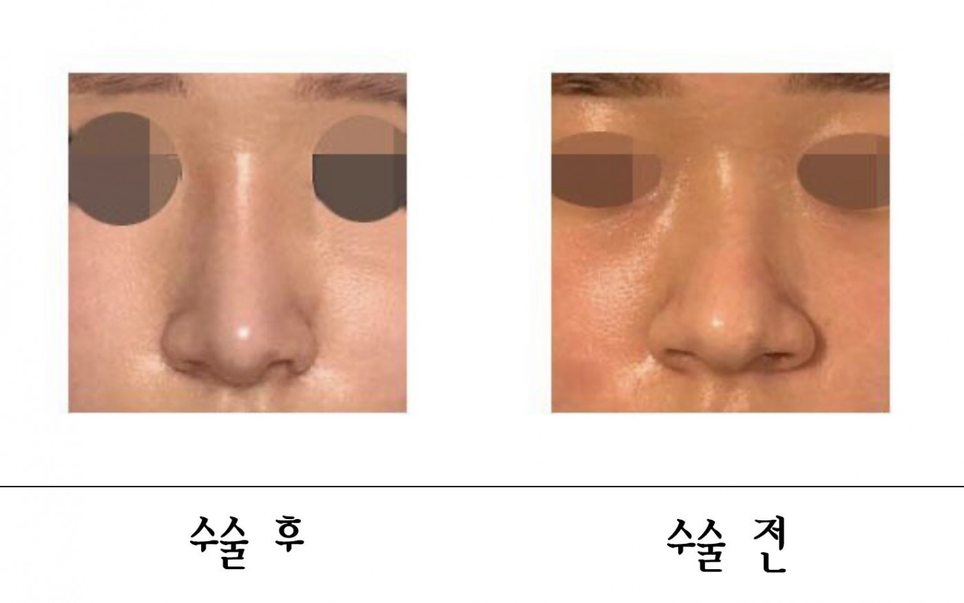 복코 수술