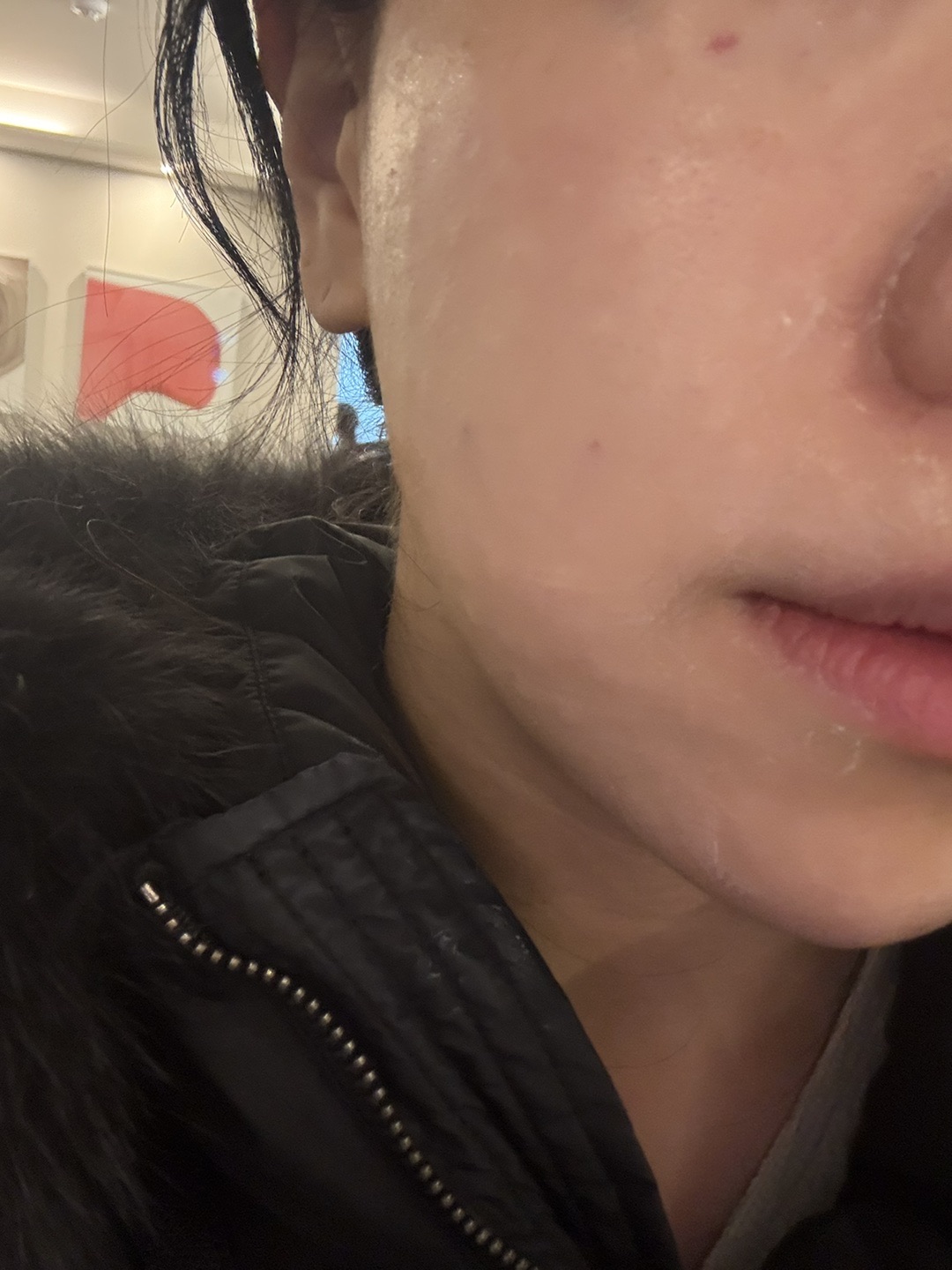 예식 전 피부관리로 왔는데 수면 리쥬란 너무 좋아요ㅎㅎ 재방문 예정!