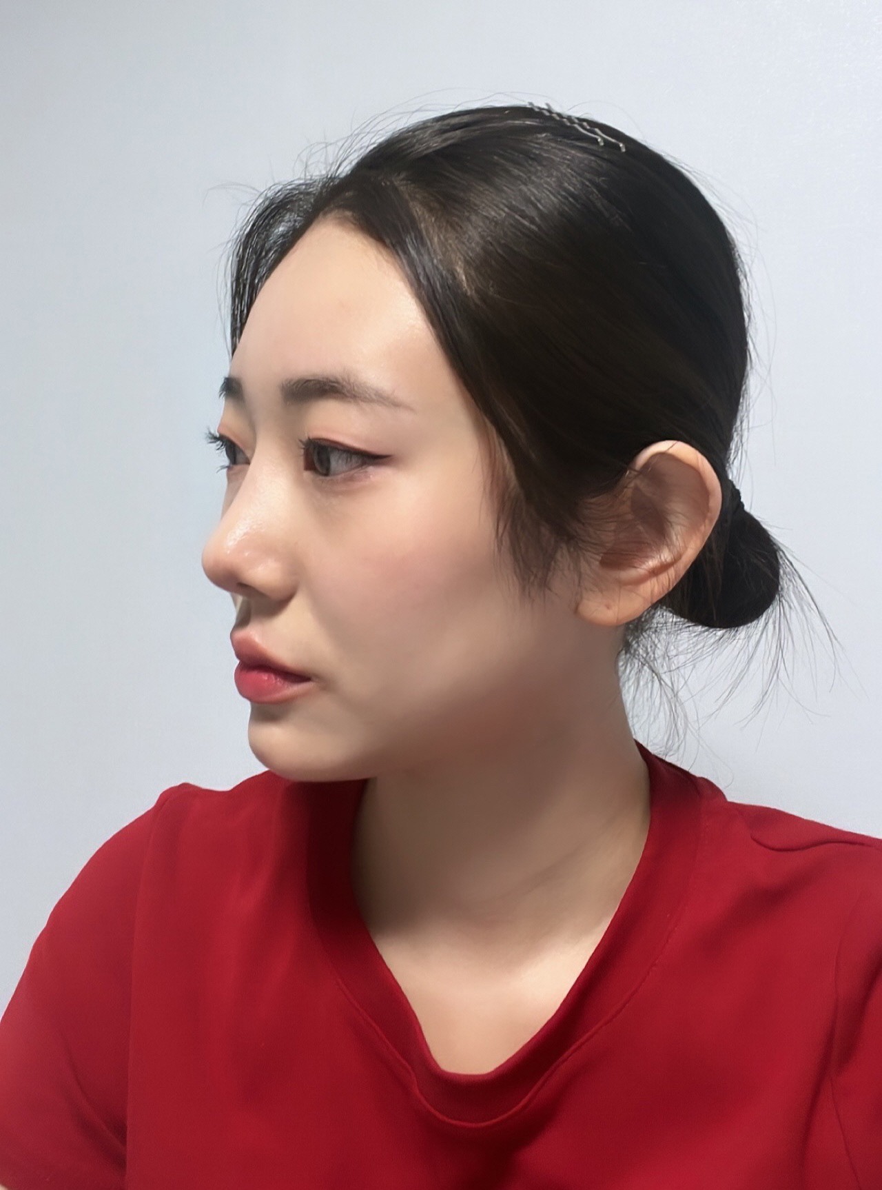 낮은 콧대도 제 얼굴에 맞게 높여주시고 라인도 잘 잡힌 것 같아서 매우 만족하고 있습니다!