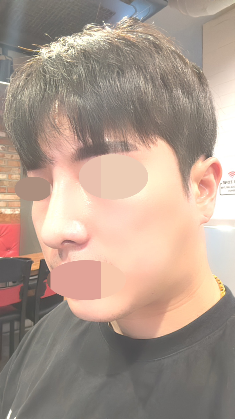 적당하게 코가 얄쌍해지고 콧볼도 줄어서 좋았습니다