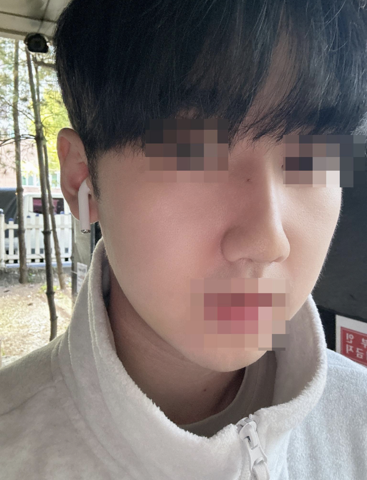 메부리코 해결