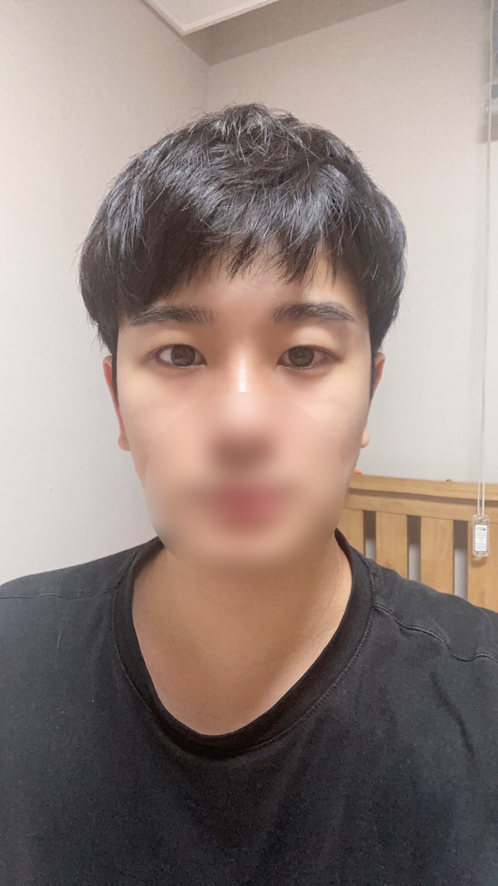 남자 눈수술 후기