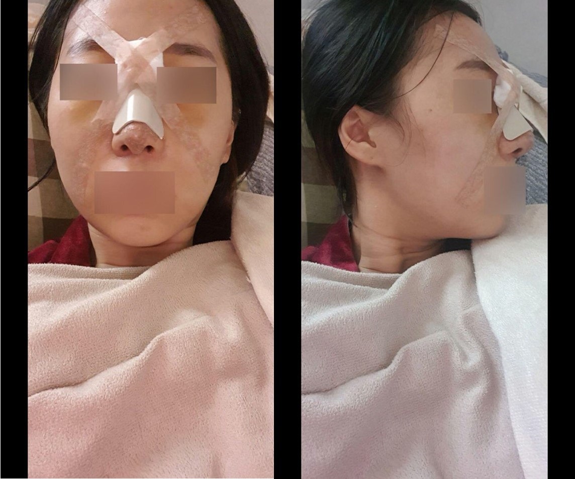 매부리 수술했어요