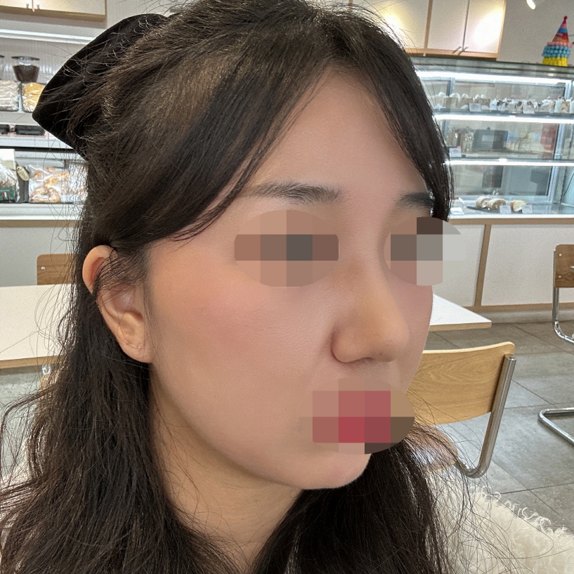 무엇보다 자연스럽고 성형한 티가 안나서 만족해요!
