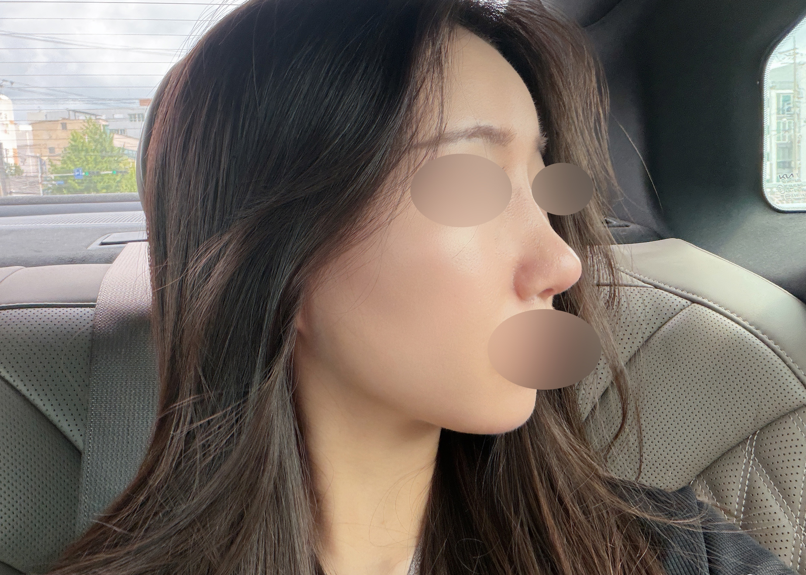 코 재수술 2달차, 원하는 모양으로 회복 중입니다~