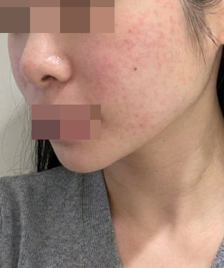 수면 진행 덕분에 안 아프게! 멍도 적어서 바로 일상 복귀 가능해요~