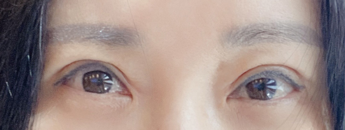 눈재수술 2주차, 아직 붓기 있지만 인상이 달라졌어요