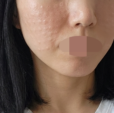 수면으로 진행해서 하나도 안 아프고 대만족으로 마무리했어요ㅎㅎ