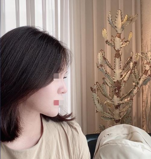 수술 4개월차 후기입니다!