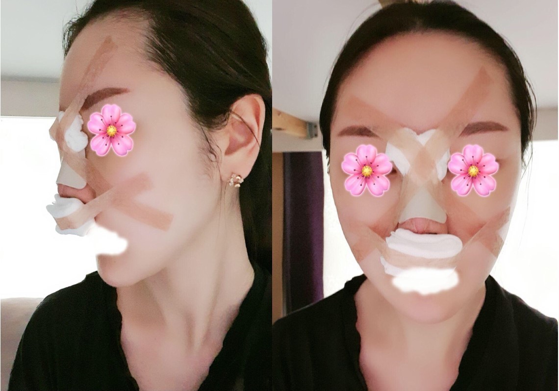 글작성 코수술 부목 중이요 ㅋ