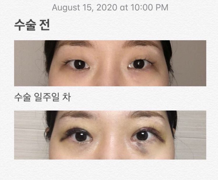 자연유착, 눈매교정, 앞트임 수술후기입니당