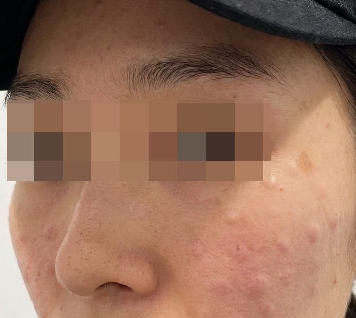 잔주름엔 스킨보톡스가 답! 만족스럽게 받고 왔어요~ㅎㅎ