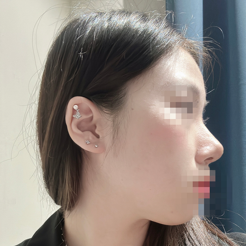 주변에서 수술 이후에 예뻐졌단 얘기도 듣고 일석이조입니다 ᄒᄒ