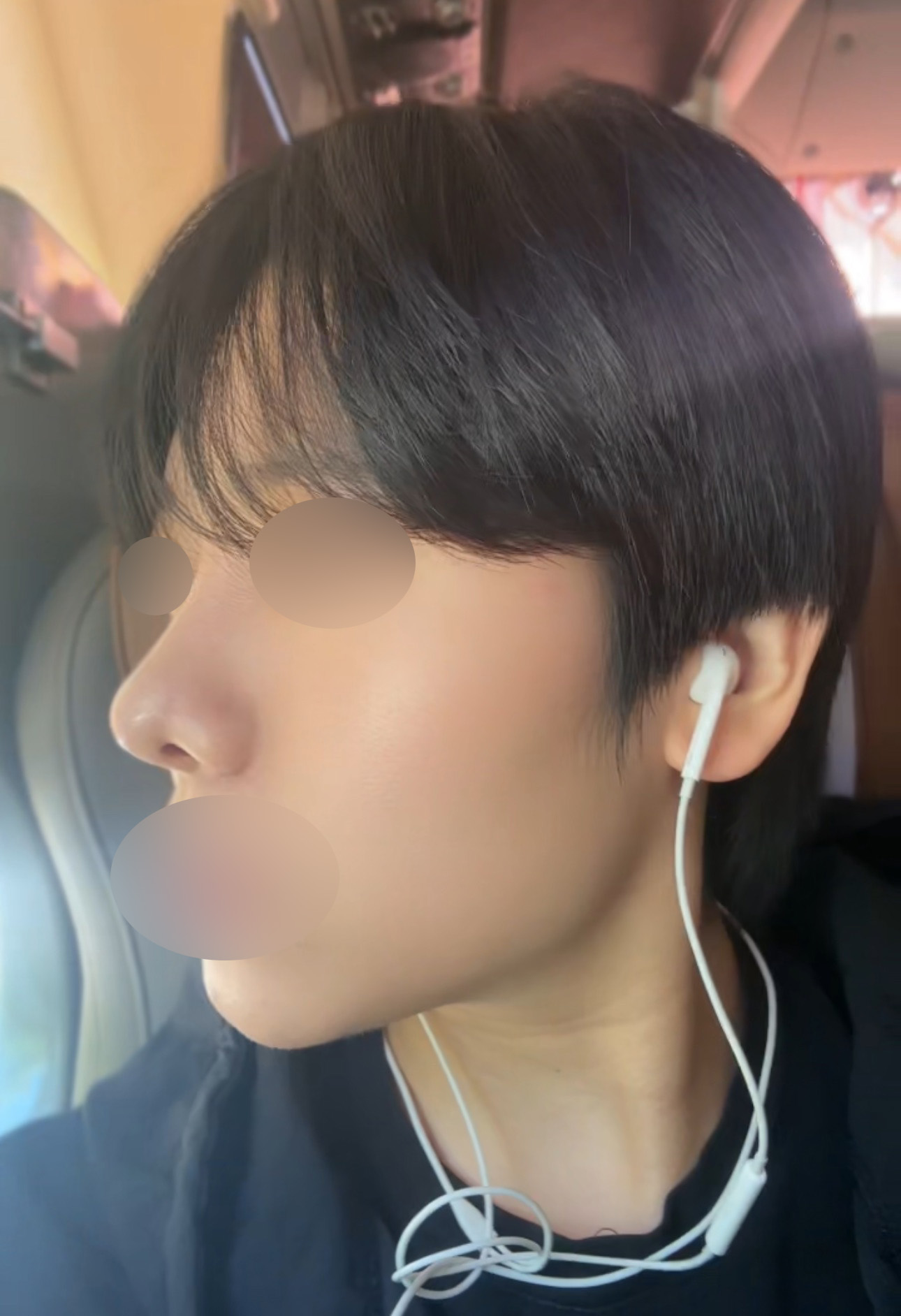 복코·매부리 교정 + 콧볼축소 2개월입니다. 생각보다 회복이 빨랐어요
