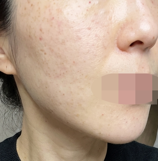 피부결이랑 흉터, 모공 고민으로 추천받아 리쥬베룩 받아봤어요~~