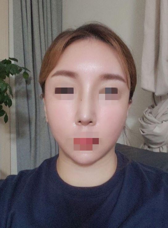 무보형물 코성형
