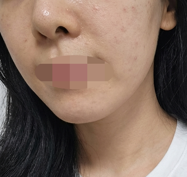 만성 건조 피부 고민, 리쥬란+리쥬란아이로 한번에 챙겼어요!