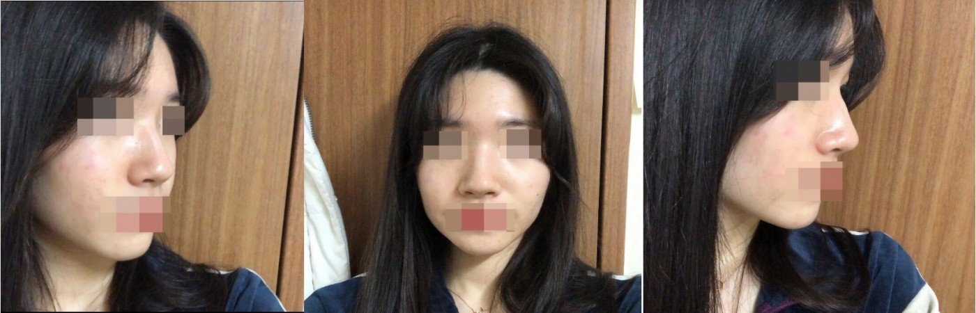 코수술 3주차 후기 올려용