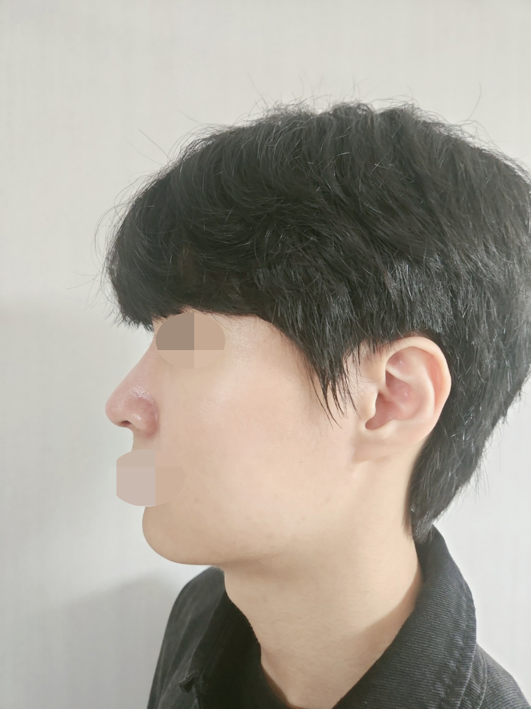 붓기 계속 빠지고 있고 지금 많이 빠졌어요