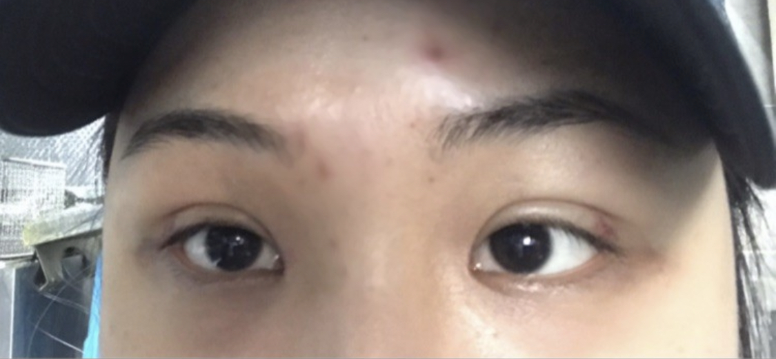 드뎌 실밥풀어요~~