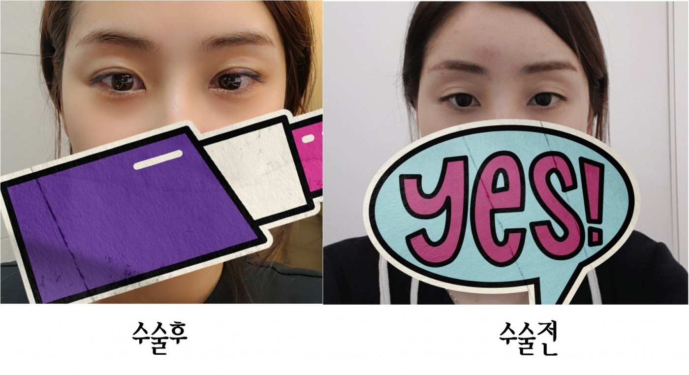 매몰 당일후기