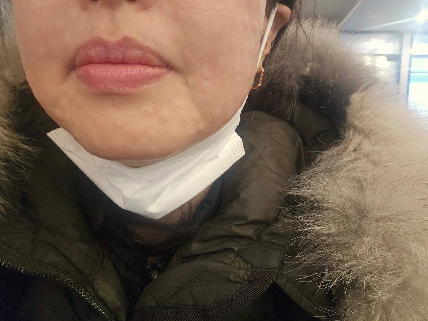 리쥬란 계속 받는 이유, 효과 좋아서 또 왔어요~
