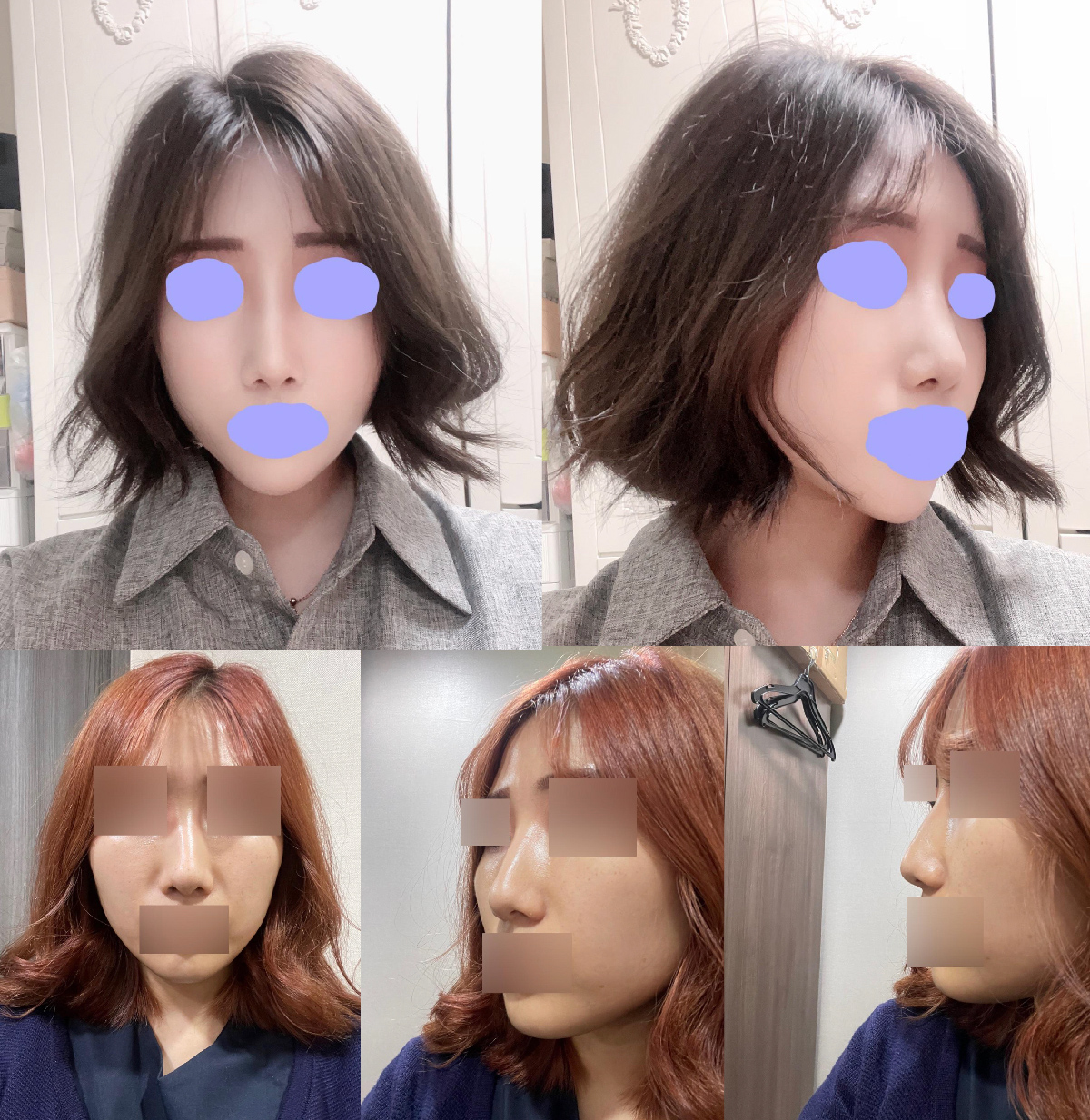 v코수술 두달째 후기v