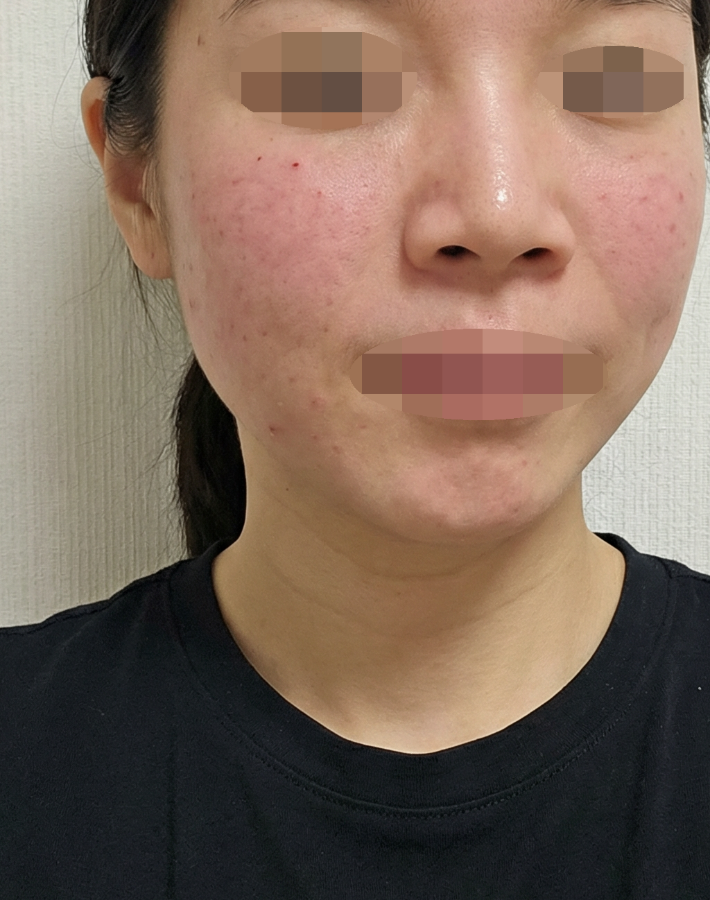 쥬베룩 받았는데 피부결 좋아져서 또 받으러 올 것 같아요 ~!