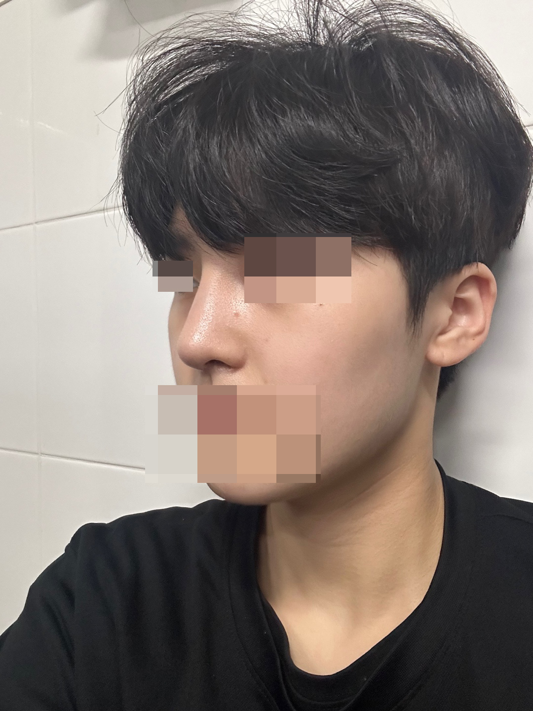 수술 후에 상태도 자세히 봐주셨어요! 자연스럽게 잡히고 있습니다 :)