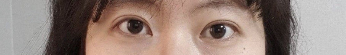 쌍커풀 재수술, 자연유착 수술받았습니다