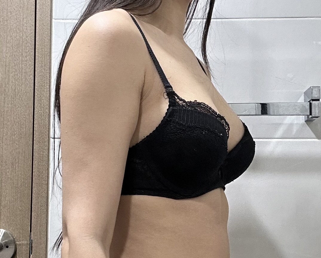 자세히 설명해주신 것 처럼 수술 잘 되어서 생착 잘 됐어요! 지금은 불편함 없이 편합니다~