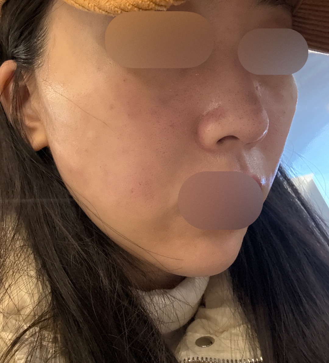 엠보 걱정했는데 마스크 없이 귀가 가능할 정도였어요!!