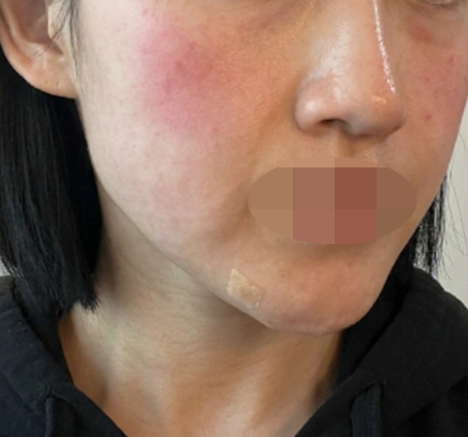 수면으로 통증 없이 받은 리쥬란, 빠른 응대까지 좋았어요ㅎㅎ