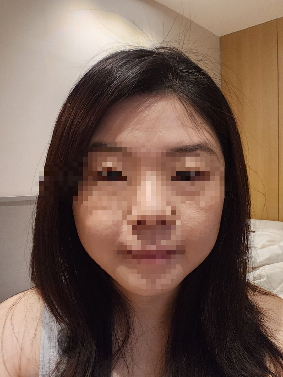 리쥬란 7일차, 피부결이 한층 매끄러워진 느낌