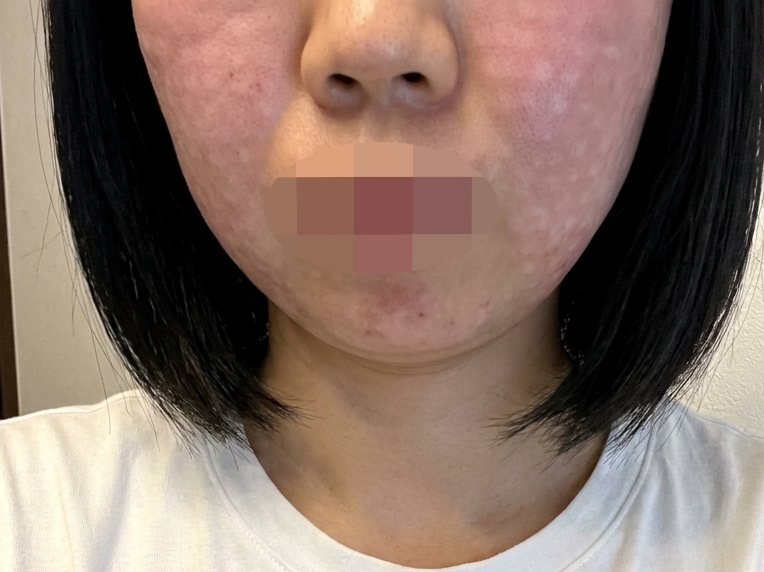 건조함 고민으로 시작한 리쥬란, 두 번째도 만족스럽게 다녀왔어요