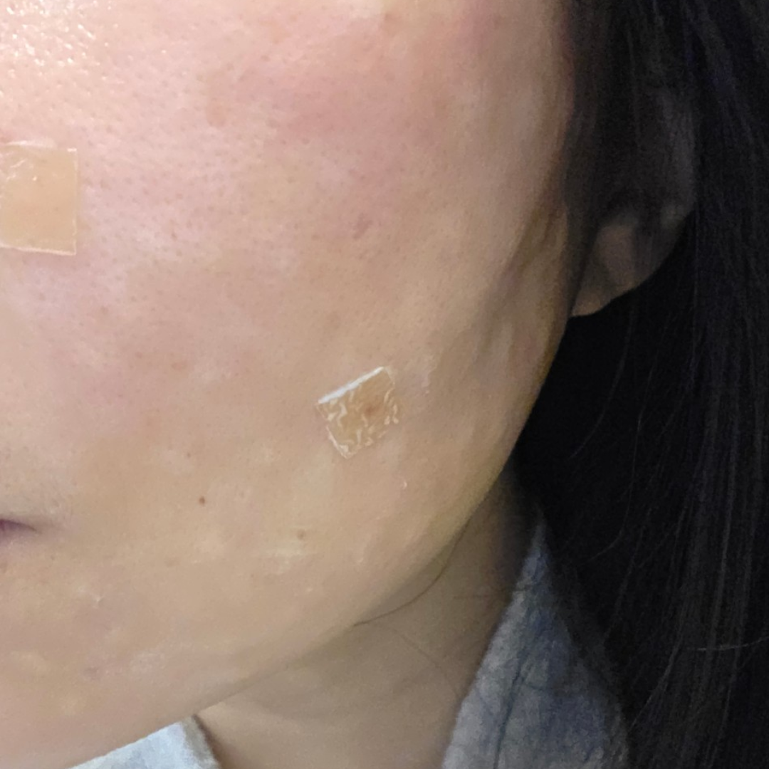 스킨보톡스랑 리투오 같이 받았는데 티 안 나고 자연스러워요