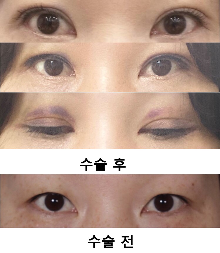 눈매교정 쌍꺼풀 매몰 수술
