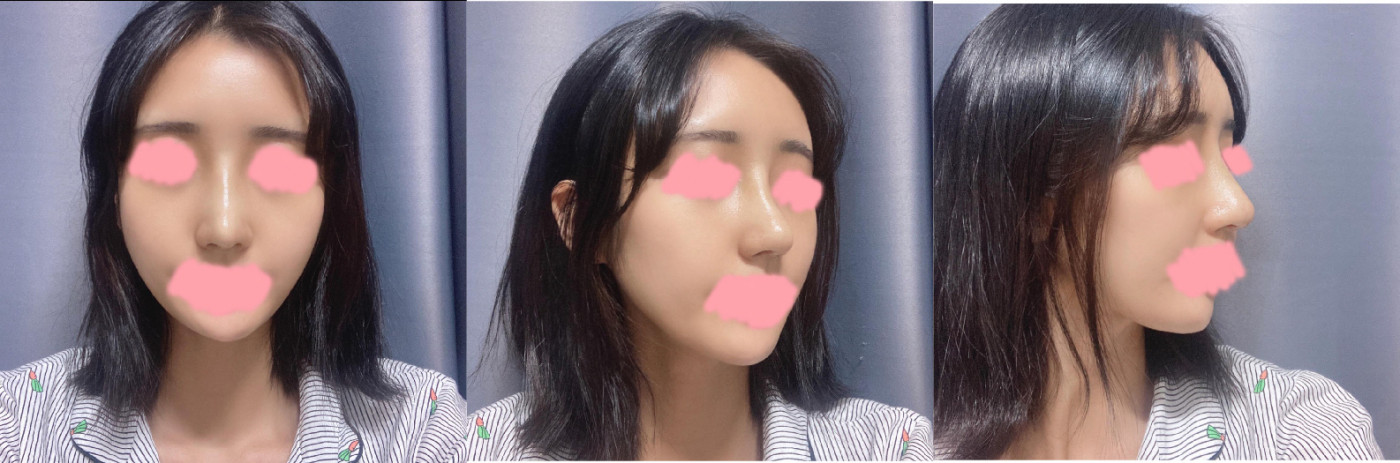 <첫코성형> 후기
