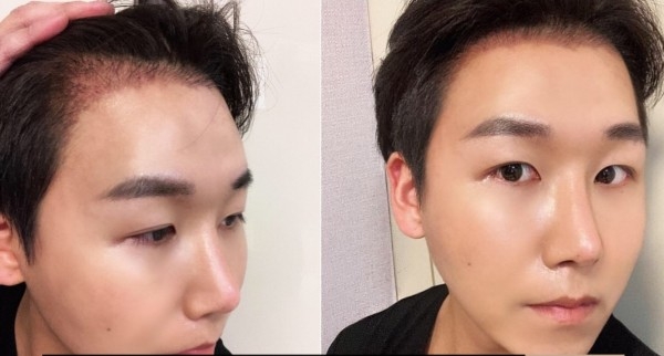 모발이식 2주차