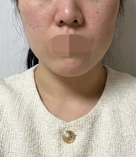몇 번이나 방문하는 곳! 이번에도 리쥬란 받았어요~