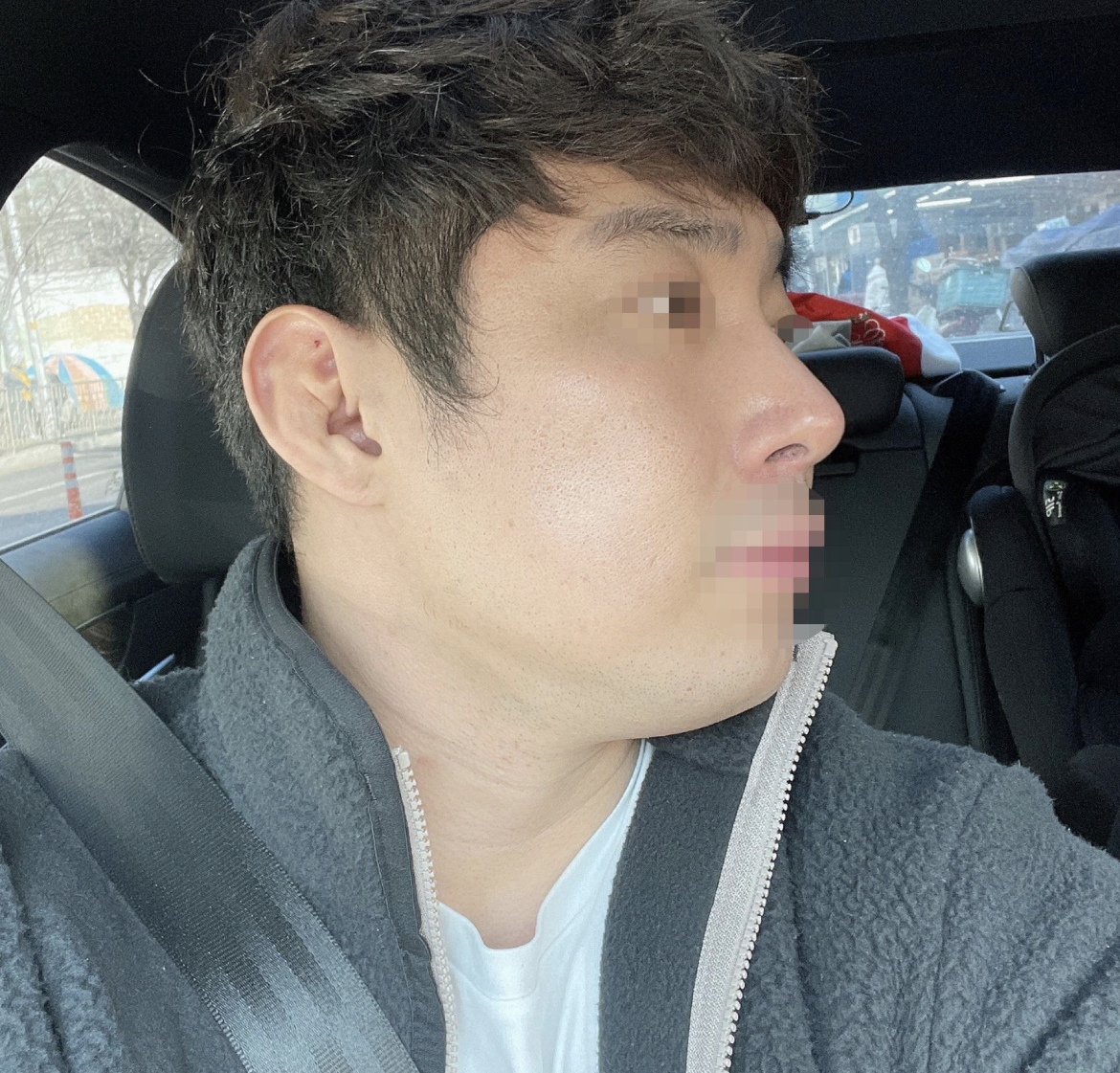 서울아이성형외과 황정일 대표원장님 강력추천합니다 코끝 진짜 잘나왔어요