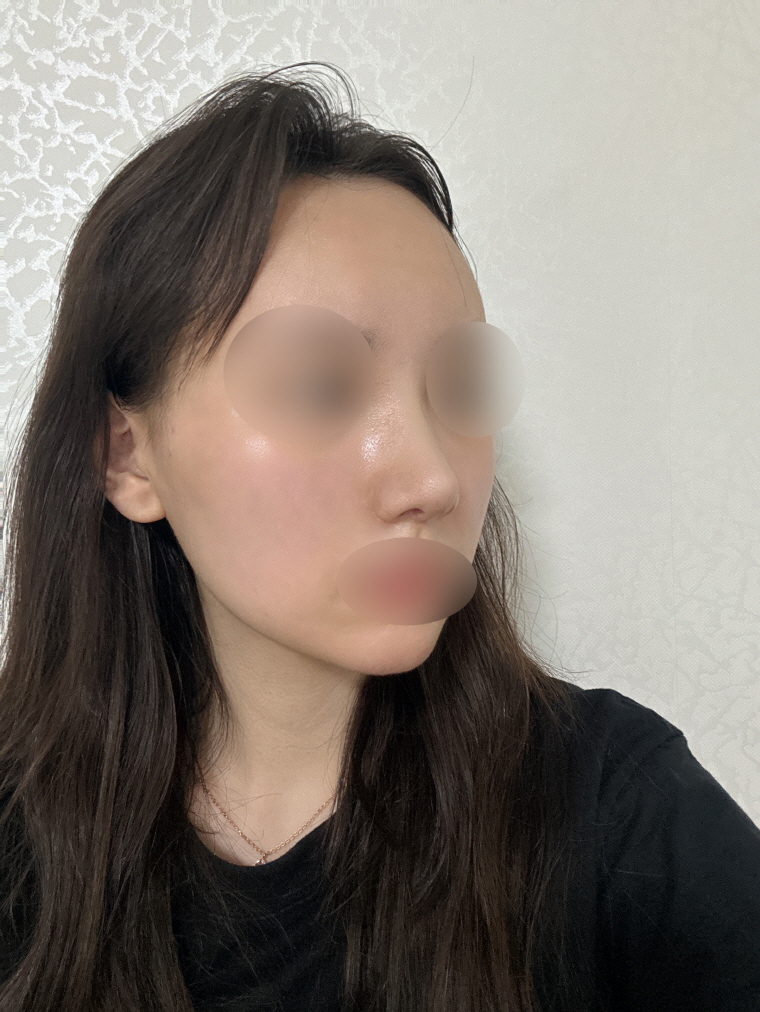 붓기가 점점 빠지고 있는데 점점 원하는 느낌으로 잘 된게 느껴져요 ㅎㅎ