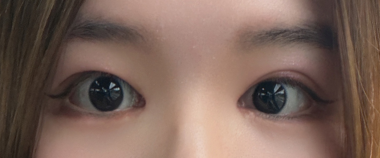 앞윗트임 1달차! 붓기 빠지며 더 자연스러워졌어요