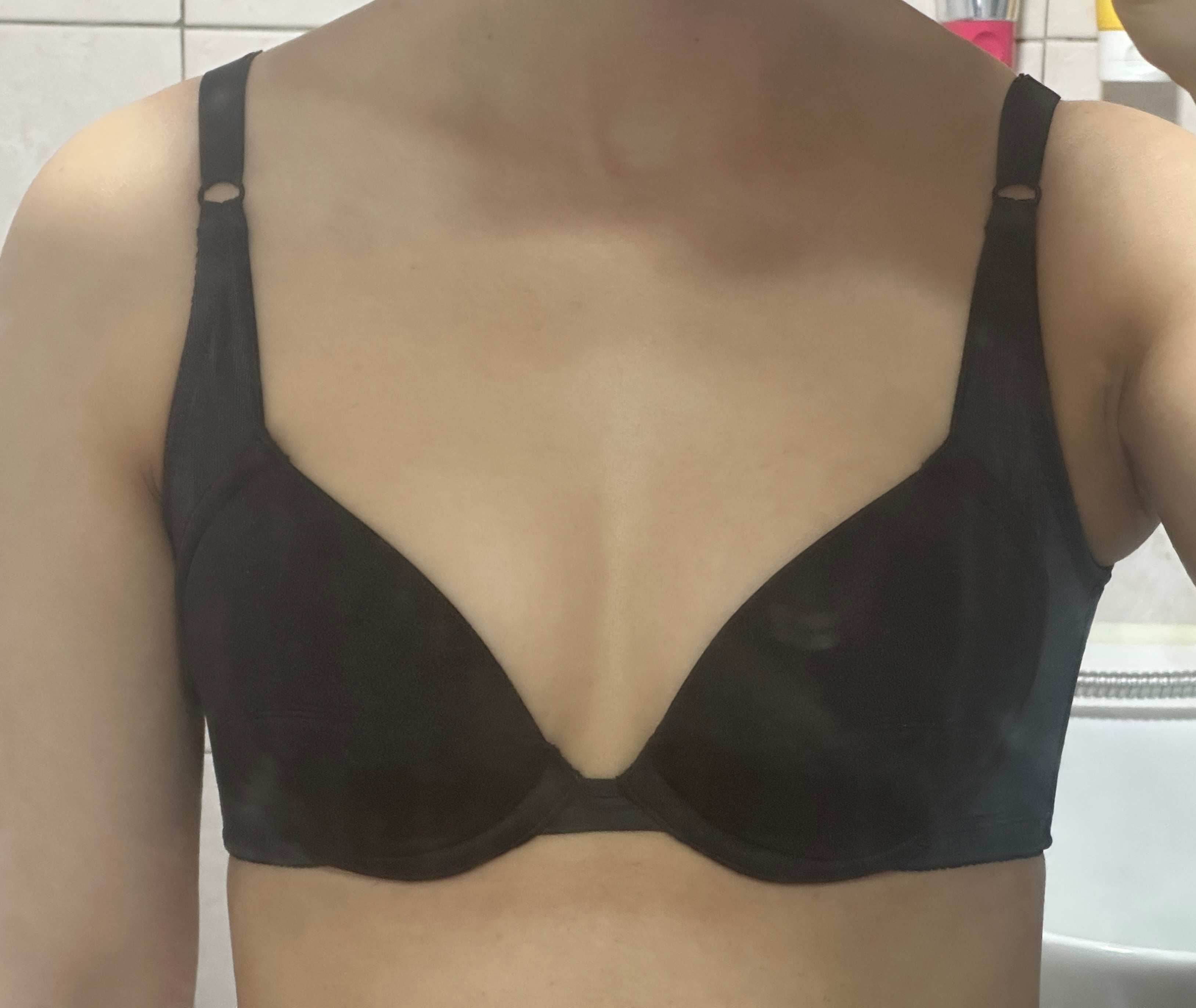 PRP 가슴지방이식 2개월차, 생착까지 고려한 선택이라 만족해요 