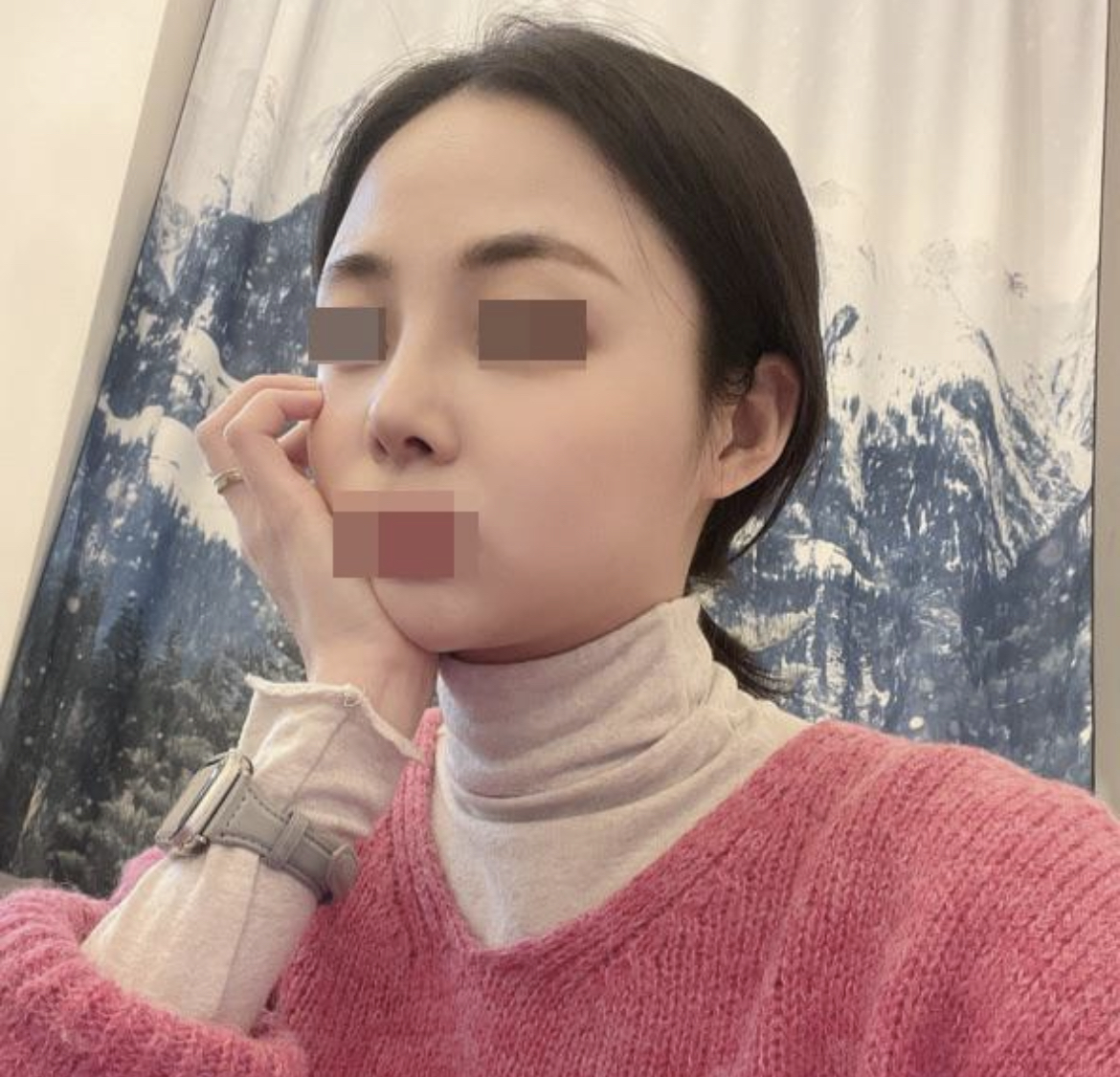 수술한지 2주째 되는날인데 너무 만족스러워요 ㅠㅠ